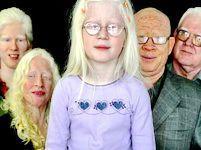 Альбинизм — причины, симптомы, диагностика